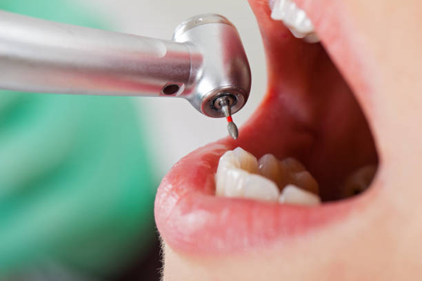 Best Emergency Dental Care for Broken or Chipped Teeth in , IA